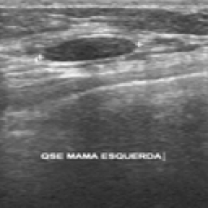 Input breast ultrasound image