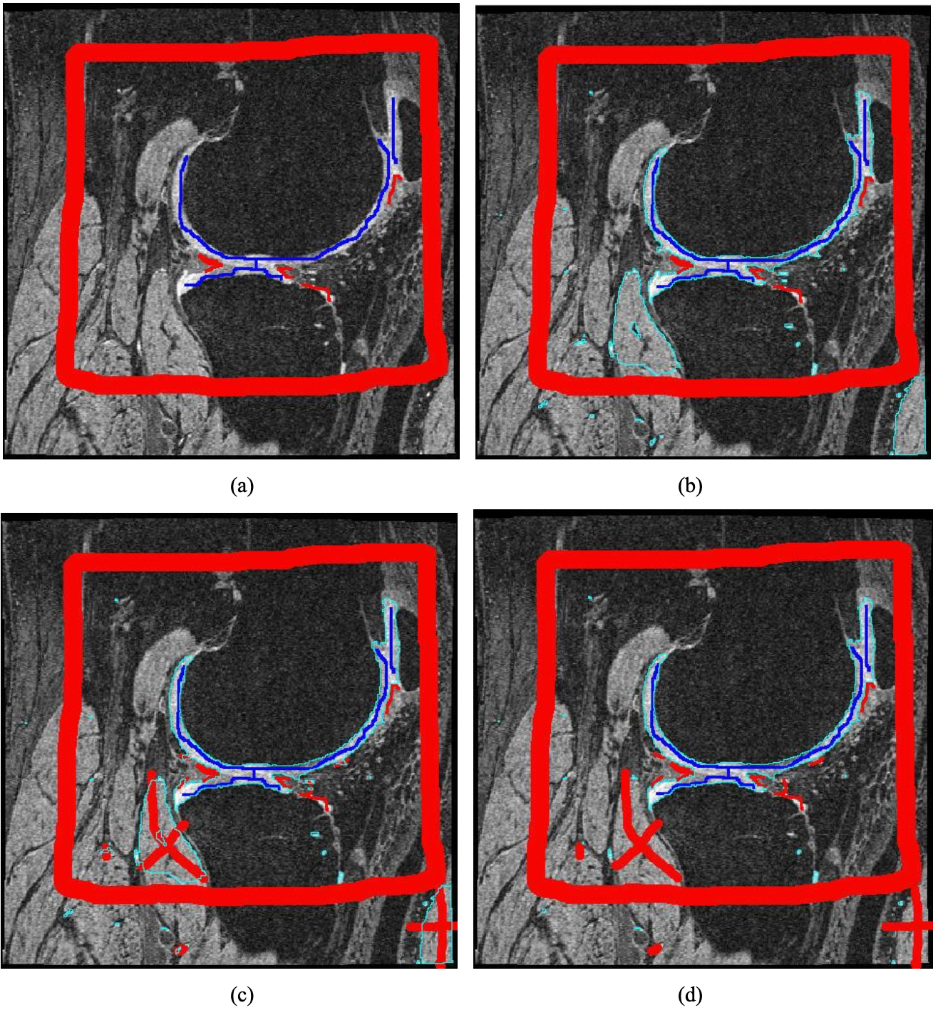 3-D segmentation of articular cartilages by graph cuts using knee MR images from osteoarthritis initiative.