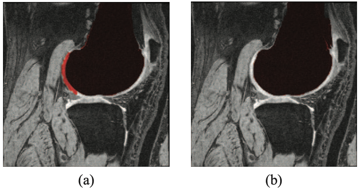 Fully automatic 3-D segmentation of knee bone compartments by iterative local branch-and-mincut on MR images from osteoarthritis initiative (OAI).