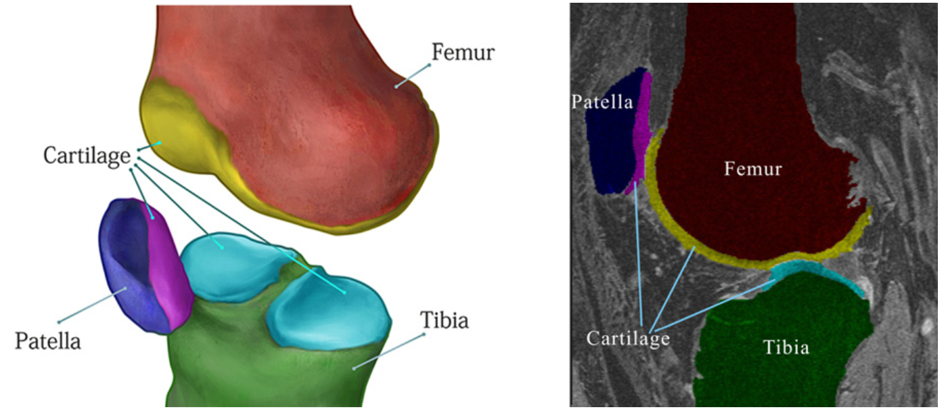 Optimization of local shape and appearance probabilities for segmentation of knee cartilage in 3-D MR images.