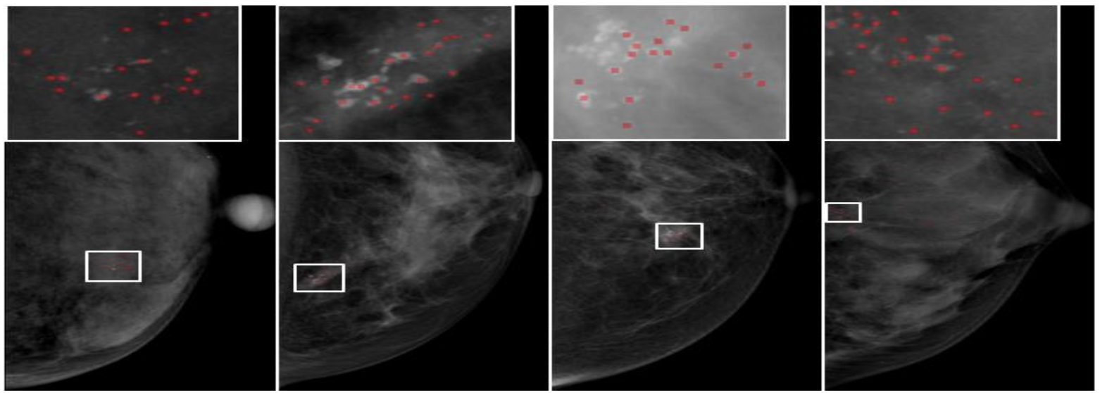 Classification based micro-calcification detection using discriminative restricted Boltzmann machine in digitized mammograms.