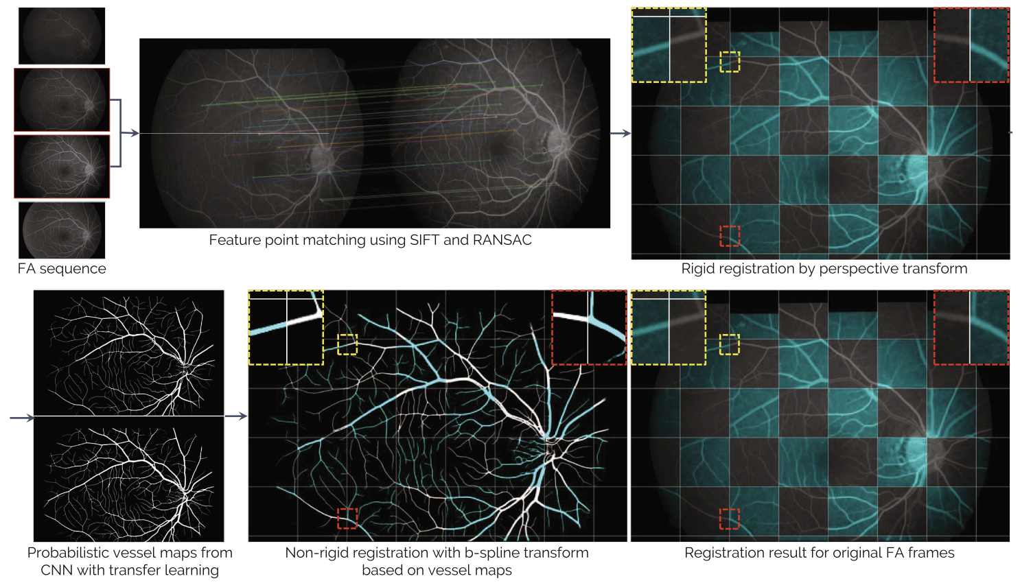 Fine-scale vessel extraction in fundus images by registration with fluorescein angiography.