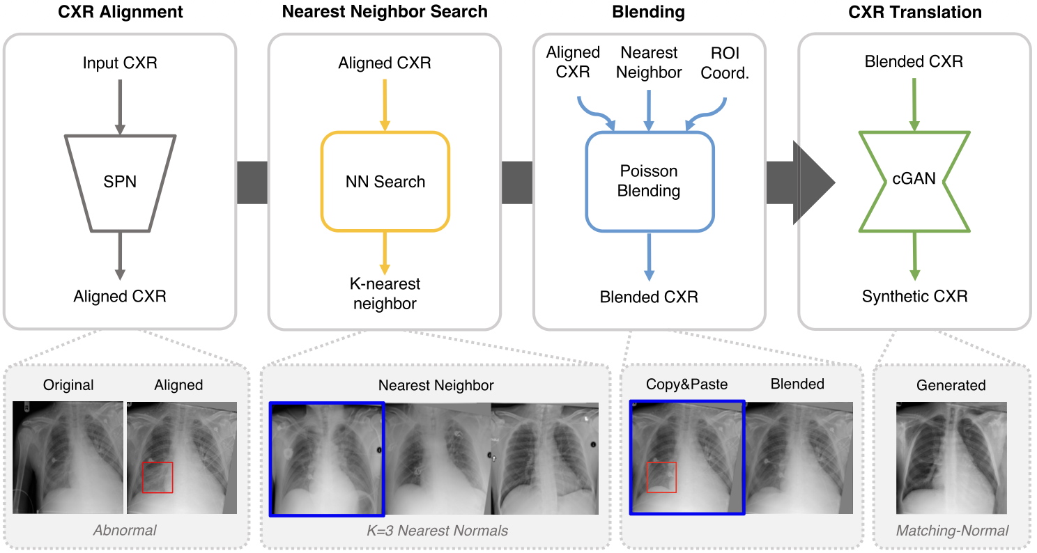 Abnormality detection in chest X-ray via residual-saliency from normal generation