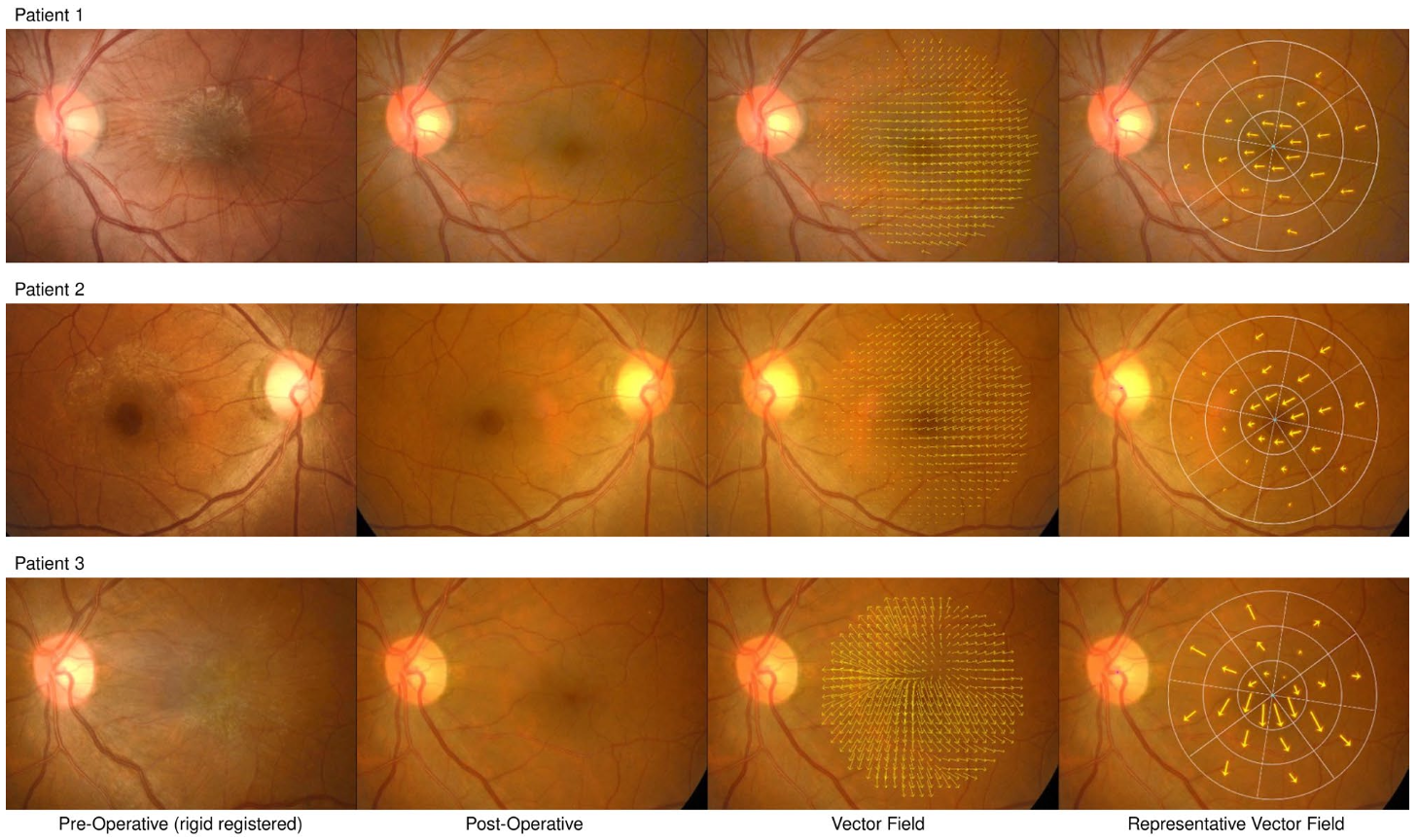 A novel vector field analysis for quantitative structure changes after macular epiretinal membrane surgery